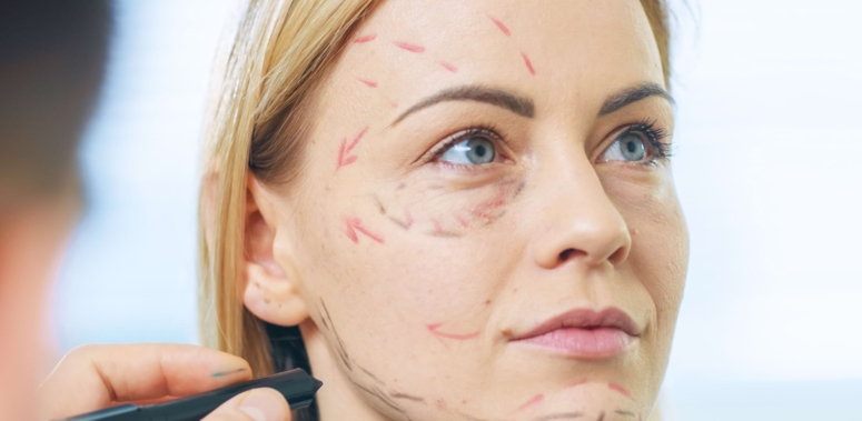 Gesichtsstraffung (Facelift)