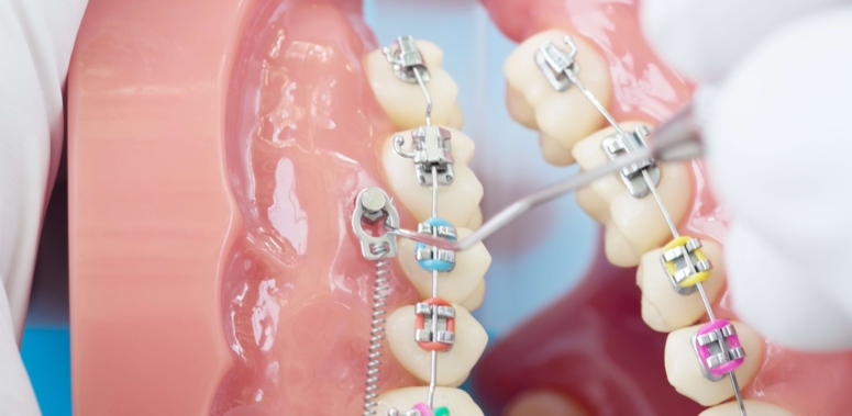 Kieferorthopädische Miniimplantate
