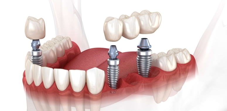 Implantate für große Zahnlücken