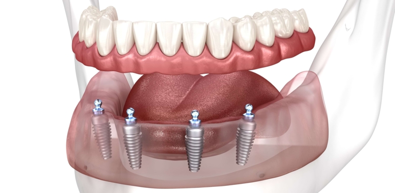 Implantate für zahnlose Kiefer