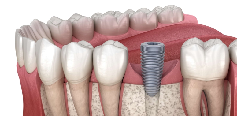 Implantate für Einzelzahnlücken