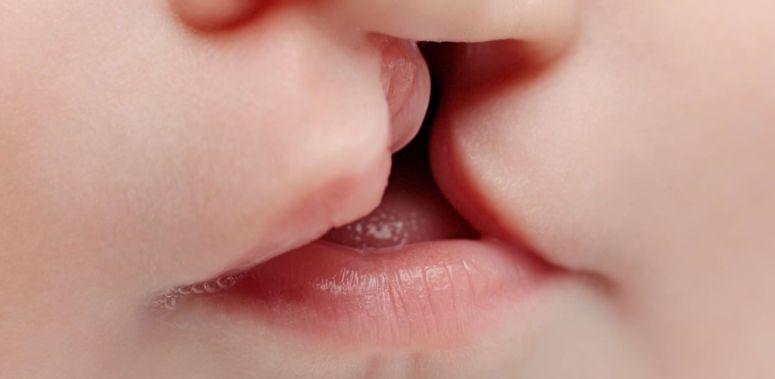 Lippen-, Kiefer-, Gaumenspaltenoperationen